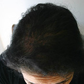 female-hair-loss-1-after