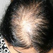 female-hair-loss-1-before