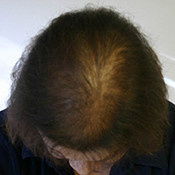 female hair loss 2 after