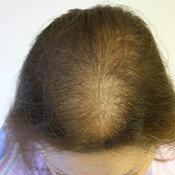 female hair loss before