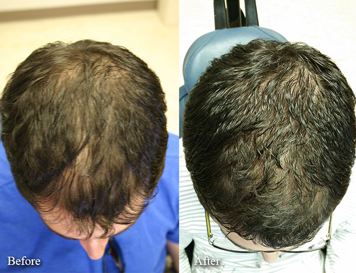 laser cap treatment before after top down