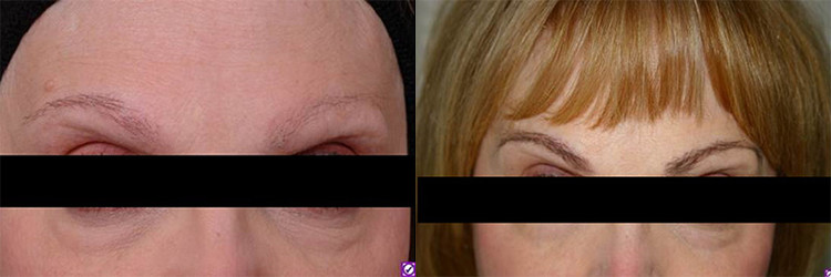 eyebrow restoration before after