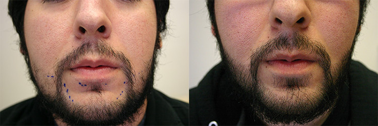 facial hair restoration before after