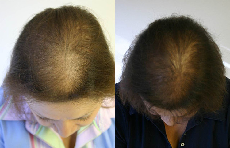 female hair loss before after