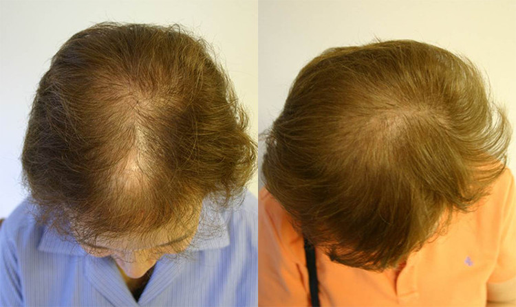 female hair loss before after