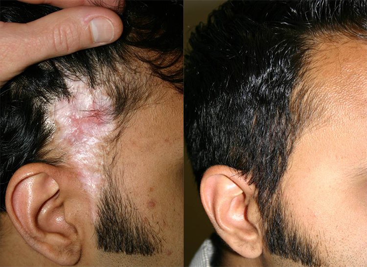 scar restoration before after