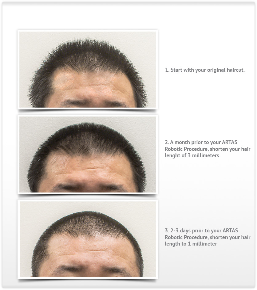 Haircuts-Examples for preparing for ARTAS Robotic Hair Transplant Procedure