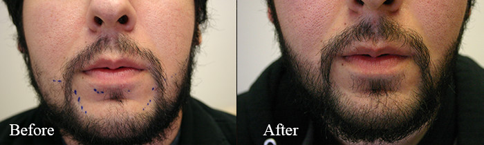 facial hair restoration patient 1