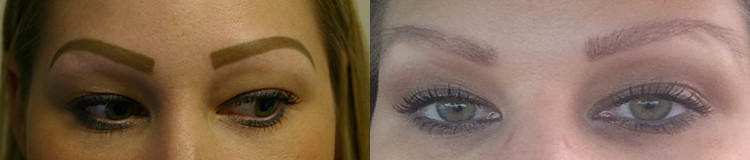 female eyebrow transplant before and after