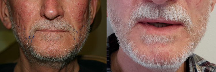 male facial hair restoration before after