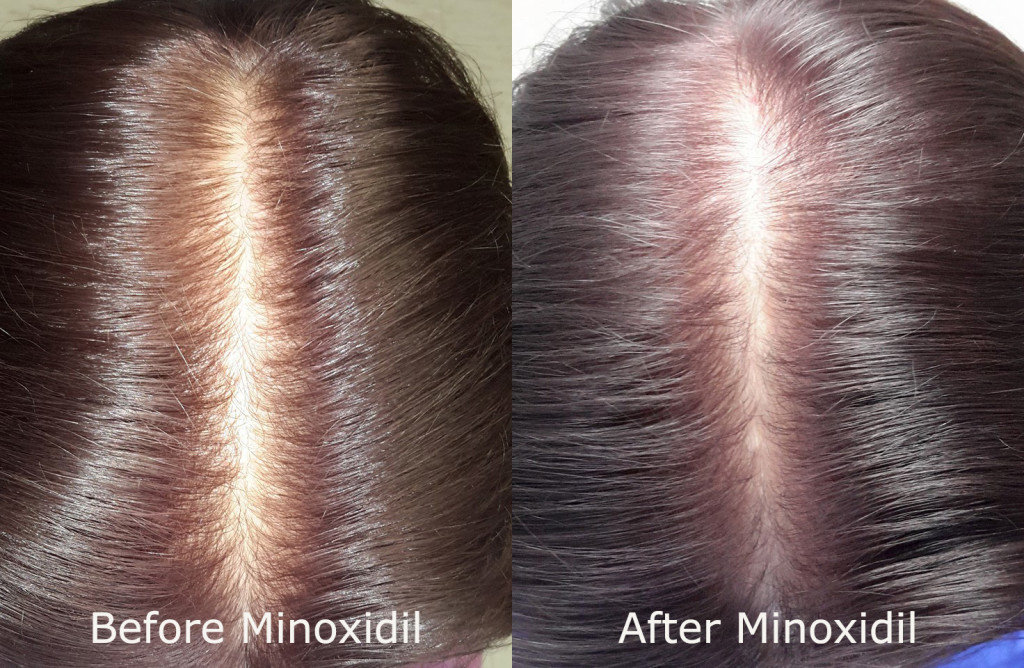 Before and After Rogaine (Minoxidil) Treatment At Limmer Hair Transplant Center