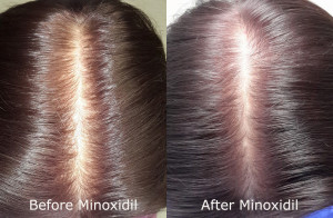 does minoxidil make hair loss worse