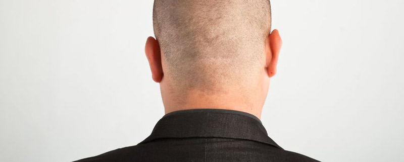 Will My Hair Transplant Scar Show If I Shave My Head?