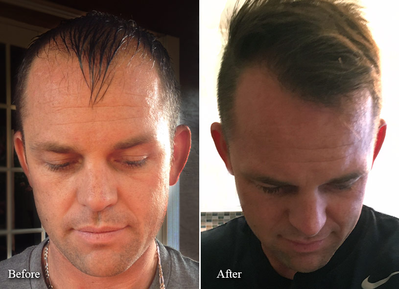 FUE Hair Transplant Patient Before and After | Limmer Hair Transplant