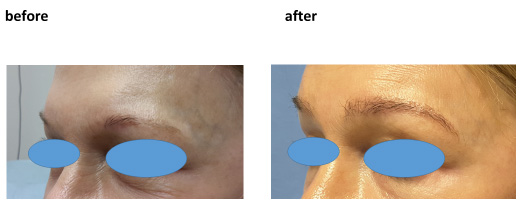 Before-and-After-Eyebrow-Transplant-at-the-Limmer-Hair-Transplant-Center