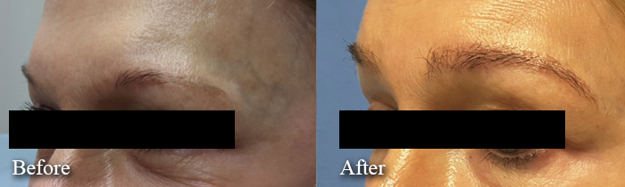 female eyebrow transplant restoration