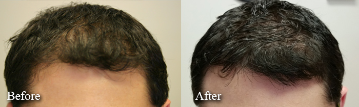 laser cap treatments before and after