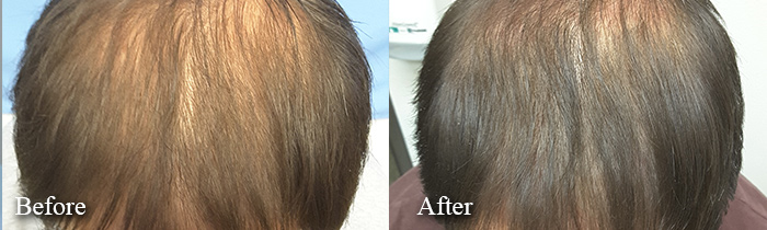 prp treatment before after male