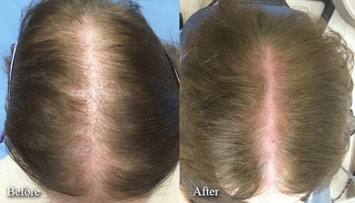 prp treatment before after woman