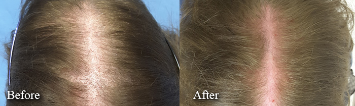 prp treatment before after female
