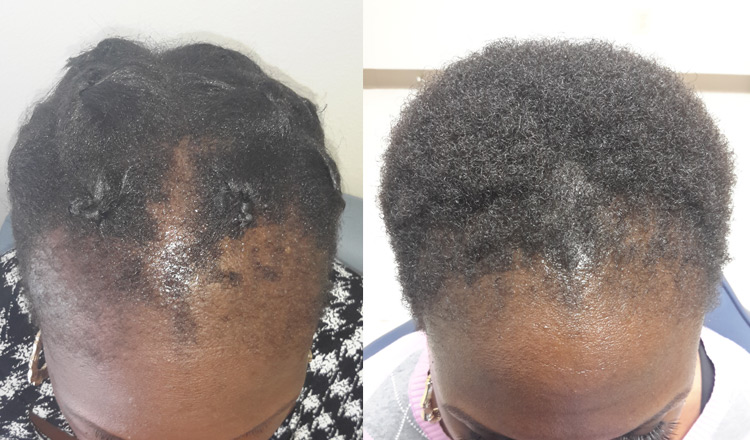 female hair transplant before after