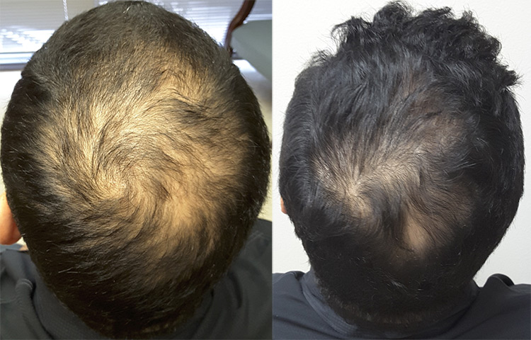 rogaine treatment before after