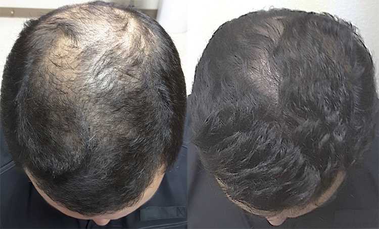 rogaine treatment before after