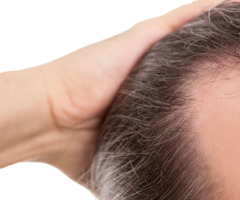 ​Receding Hairline Stages: What You Can Expect To See As It Gets Worse