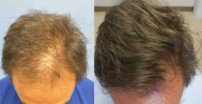 male hair transplant finasteride before after