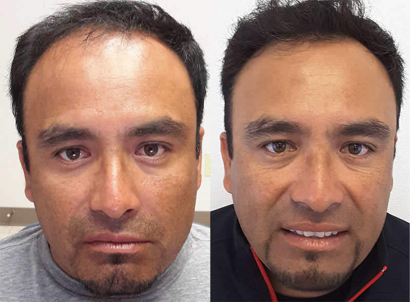 male hair transplant FUT before after
