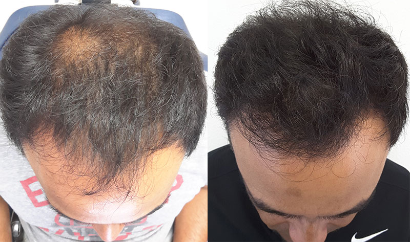 male hair transplant FUT before after