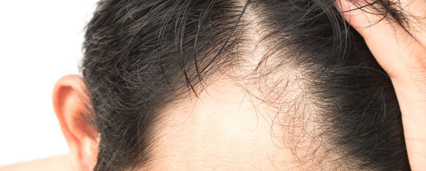 Minoxidil: Your Questions, Answered