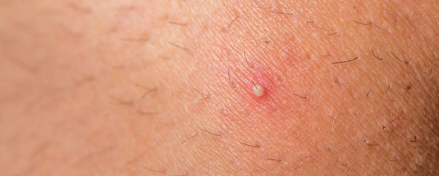 What Is Folliculitis and What Does it Have to do With Hair Transplants?