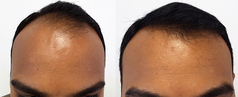 mail hair transplant before after