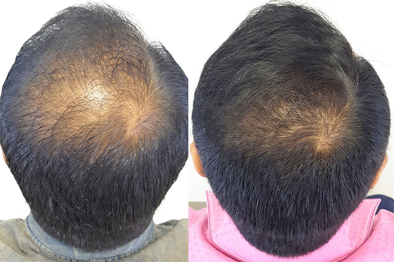 mail hair transplant before after