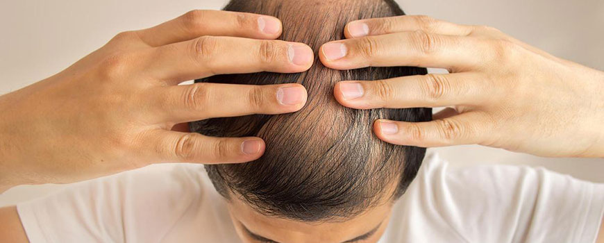 Can You Get a Hair Transplant from a Third Party Donor?