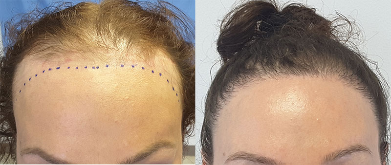 Female Hair Transplant - Male to Female Transgender | Before & After