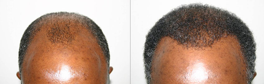 african american hair transplant