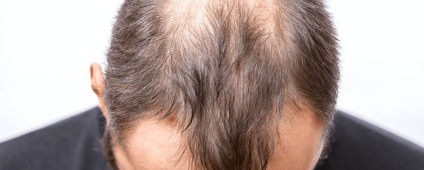 5 Most Common Reasons for Hair Loss in Men