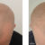 What is Scalp Micropigmentation and How Long Does it Last?