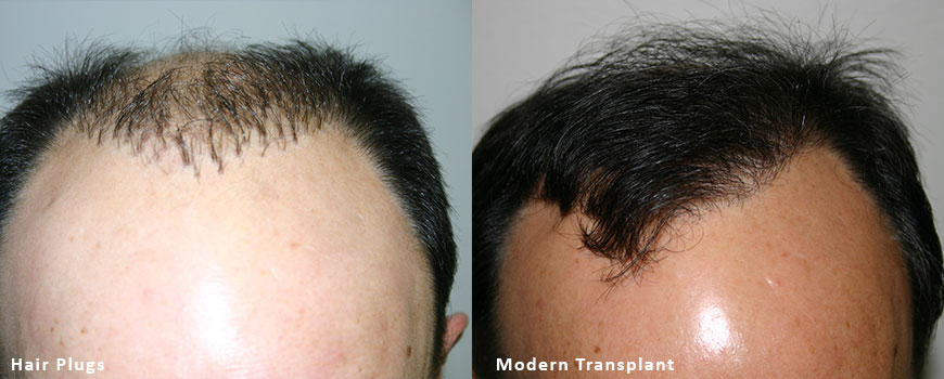 hair plugs vs modern hair transplants