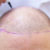 What Are the Disadvantages of a Hair Transplant?