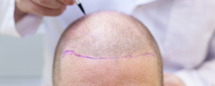 What Are the Disadvantages of a Hair Transplant?