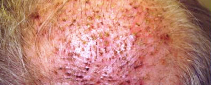 Can a Hair Transplant Become Infected?