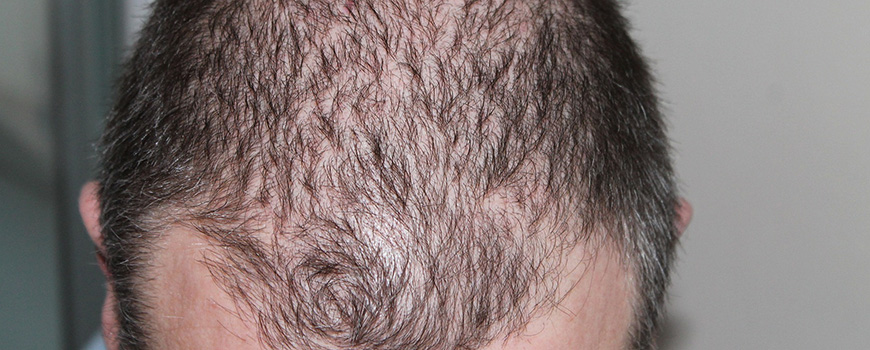 Diffuse Pattern Alopecia vs. Diffuse Unpatterned Alopecia