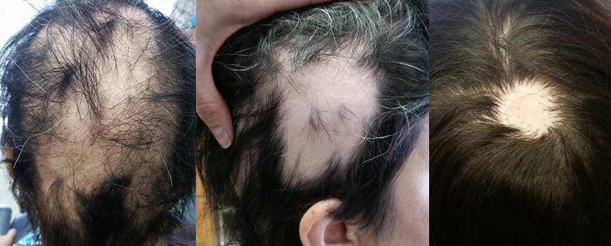 Uncommon Causes of Hair Loss Not Caused by Genetics