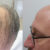 Norwood 6 Hair Transplant Results and Medicinal Therapy Options