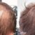 Hair Transplant Recovery – What to Expect in the First Year