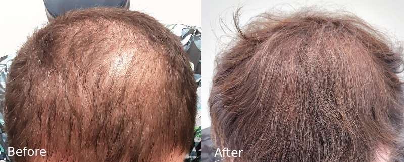 Hair Transplant Recovery – What to Expect in the First Year