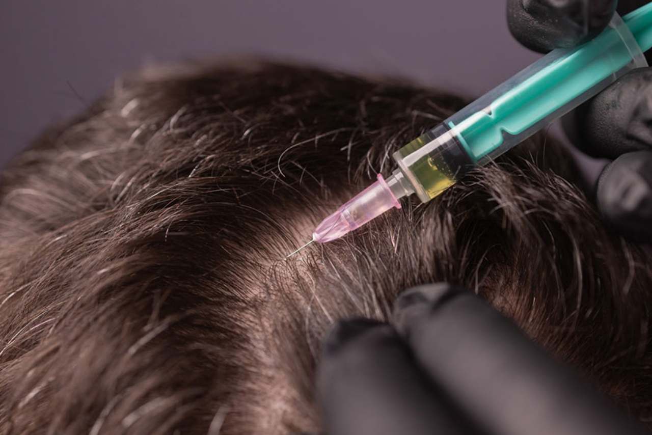 prp injections hair loss